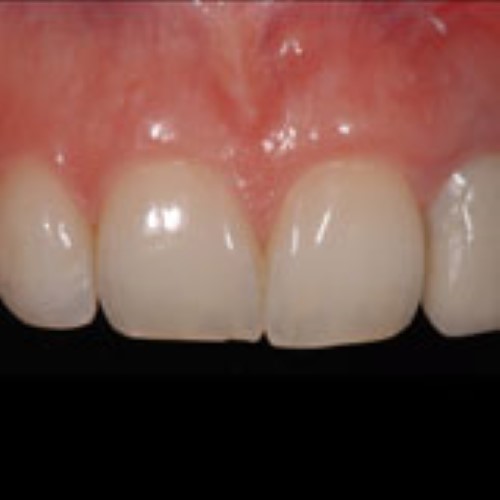 Hopeless lateral incisor in a young patient